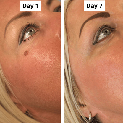 PURALEA™ Skin Tag Removal Kit