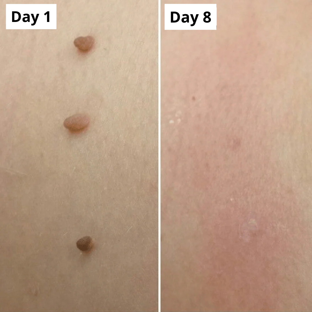 PURALEA™ Skin Tag Removal Kit