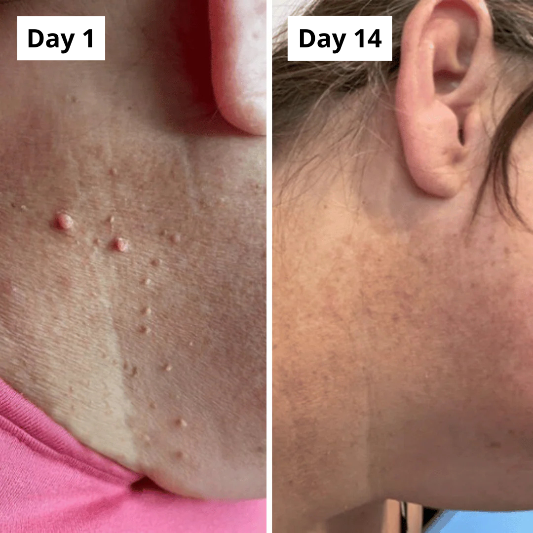 PURALEA™ Skin Tag Removal Kit