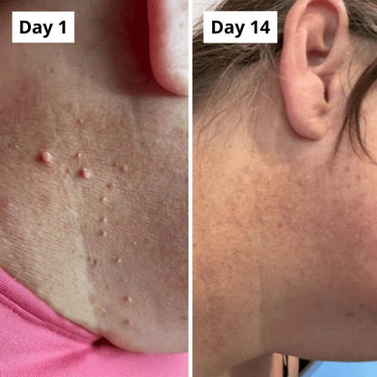 PURALEA™ Skin Tag Removal Kit